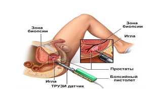 Биопсия предстательной железы. Последствия и возможные осложнения