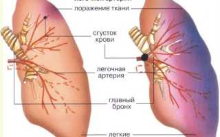 Подробный ответ на вопрос: что такое тромбоэмболия?